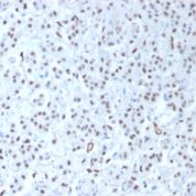 FFPE human mesothelioma sections stained with 100 ul anti-Wilms Tumor 1 (clone WT1/1434R) at 1:200. HIER epitope retrieval prior to staining was performed in 10mM Citrate, pH 6.0.